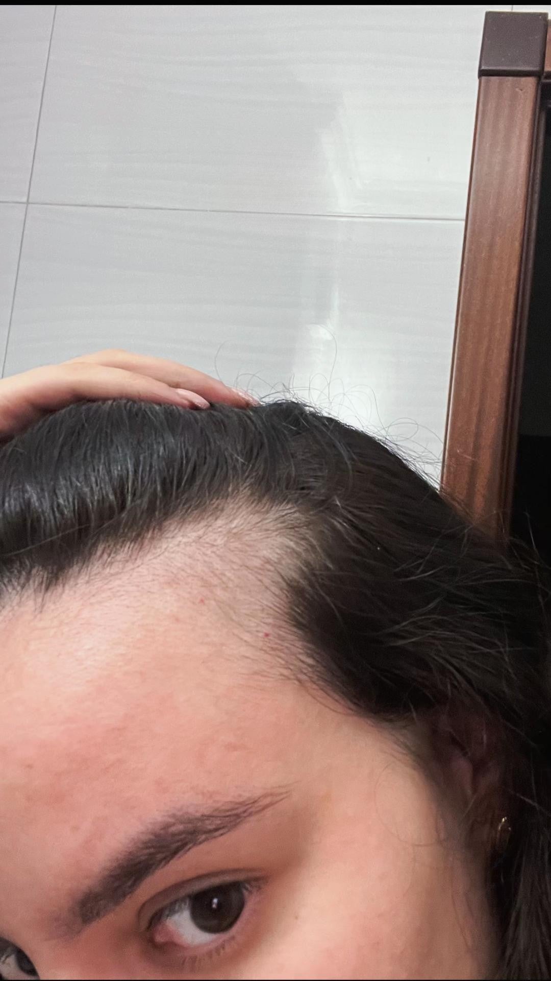 Before hair growth treatment
