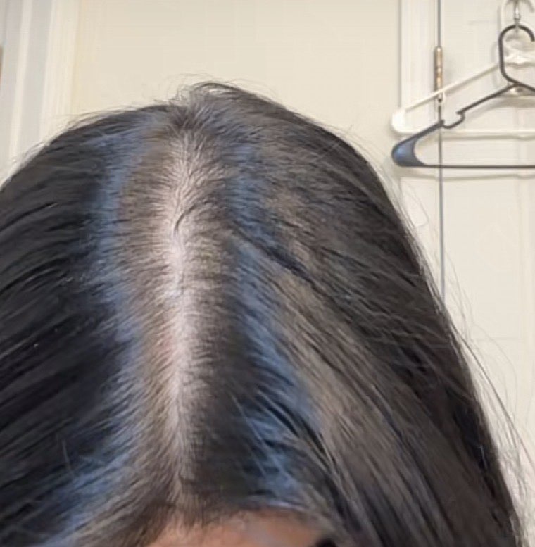 After hair growth treatment