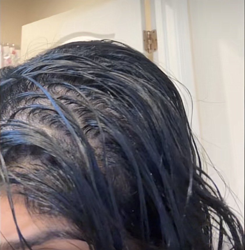 Before hair growth treatment